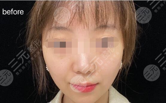 光电提拉抗衰果前