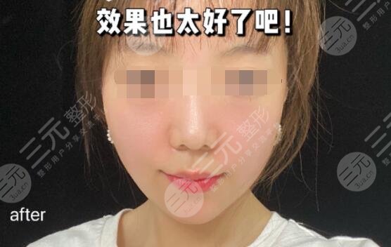 光电提拉抗衰果后