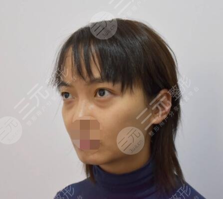 光电提拉去眼袋的优势