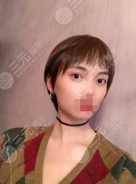 光电提拉去眼袋的果