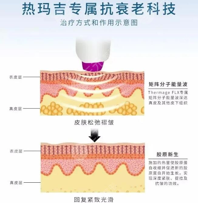 4代热玛吉900发和1200区别