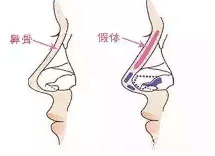 怎么才能让鼻子变高