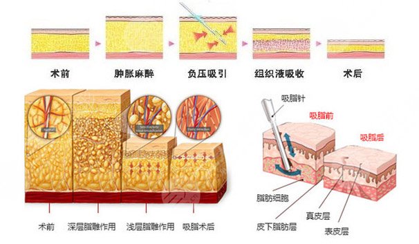 冷冻溶脂减肥靠谱吗