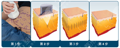 冷冻溶脂和抽脂哪个果好