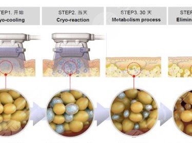 冷冻溶脂和抽脂哪个果好
