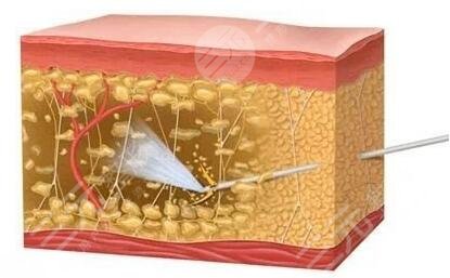 射频瘦小腿**吗？成好吗？注意事项分享，美腿秘籍公开！