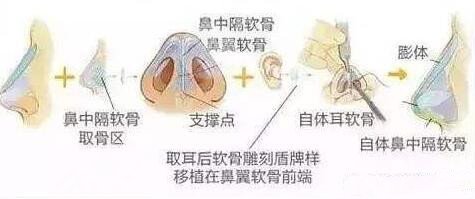 耳软骨鼻子术后注意事项