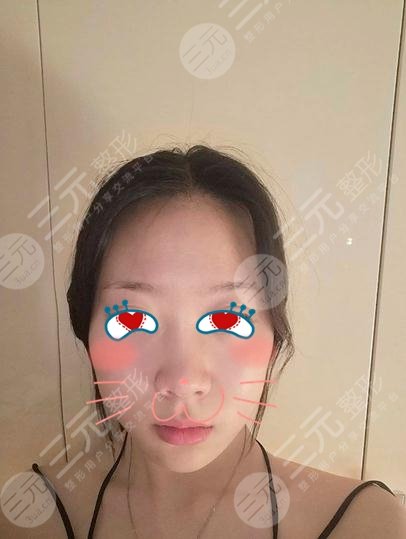 上海九院丁伟拉皮术后果，皮都展开了