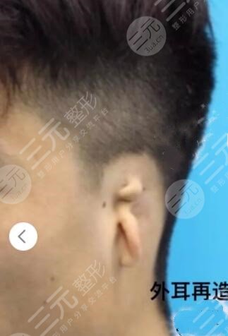 耳再造手术的注意事项