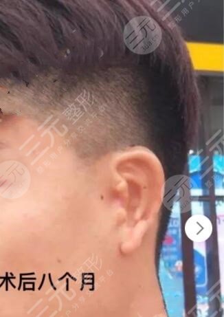 耳再造手术后