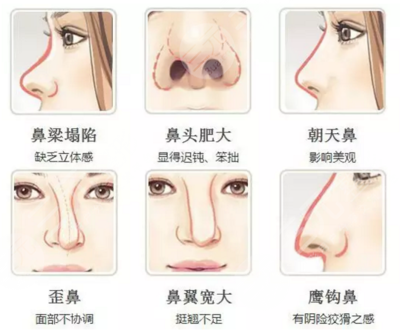 上海隆鼻手术大概价位