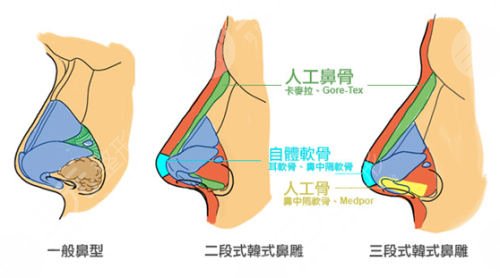 上海隆鼻手术大概价位