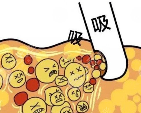 上海腰腹部抽脂减肥价格