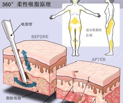 上海腰腹部抽脂减肥价格