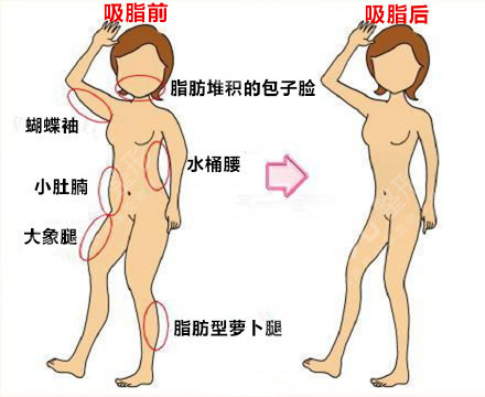 上海腰腹部抽脂减肥价格