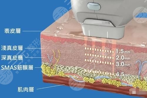 光电提拉做一次多少钱