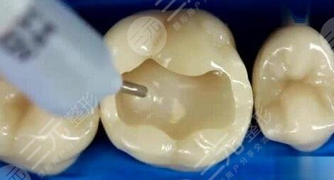 牙齿缺损的修复方法