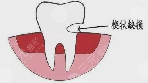 牙齿缺损的修复方法