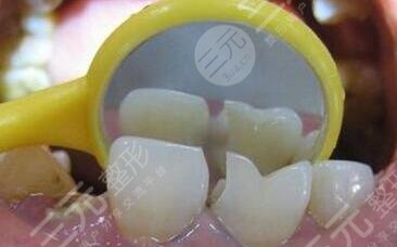 牙齿缺损的修复方法