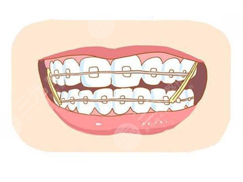什么是龅牙矫正?