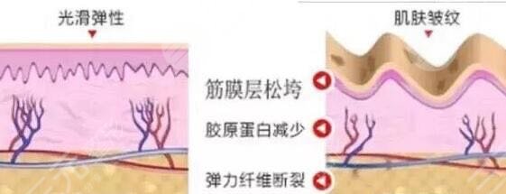 热玛吉副作用有哪些