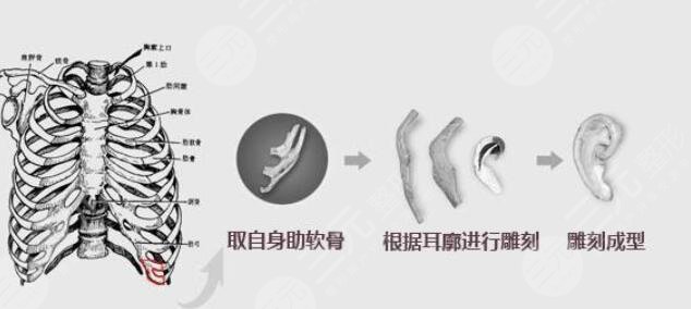 耳再造全包手术的原理