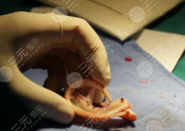 耳再造整形手术注意事项