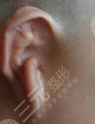 耳再造手术前