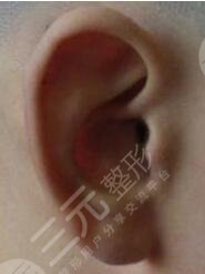 耳再造手术后