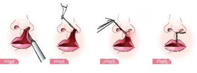 唇腭裂修复手术的过程
