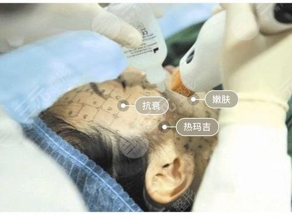 做热玛吉需要多长时间做完?热玛吉维持时间、果、你了解多少? 做热玛吉需要多长时间做完?热玛吉维持时间、果、你了解多少?