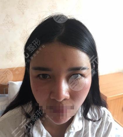 超体隆鼻整形前