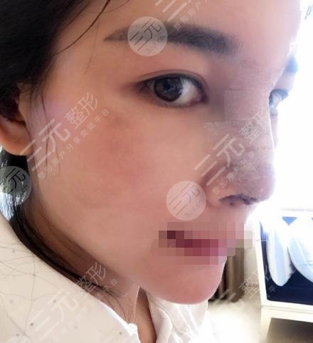 超体隆鼻整形后3天