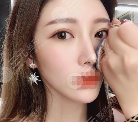 超体隆鼻大概是什么价格超体隆鼻贵不贵看完你可能会惊讶