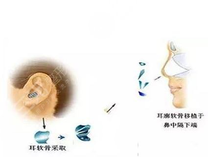 耳软骨鼻手术后?注意事项