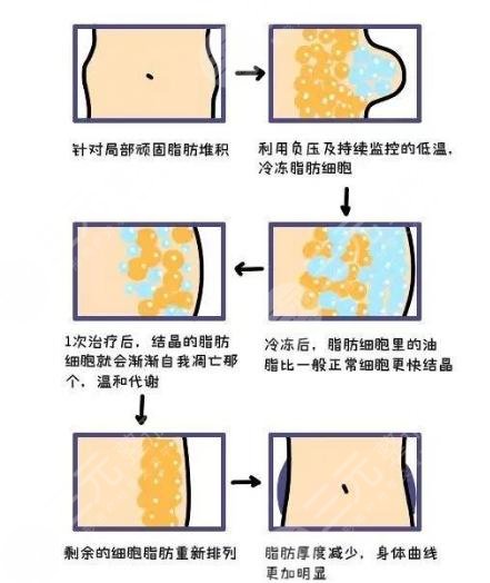 酷塑冷冻溶脂价格多少钱?价格影响因素+酷塑冷冻溶脂前后案例果