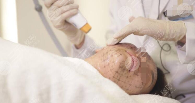 热玛吉除皱的果