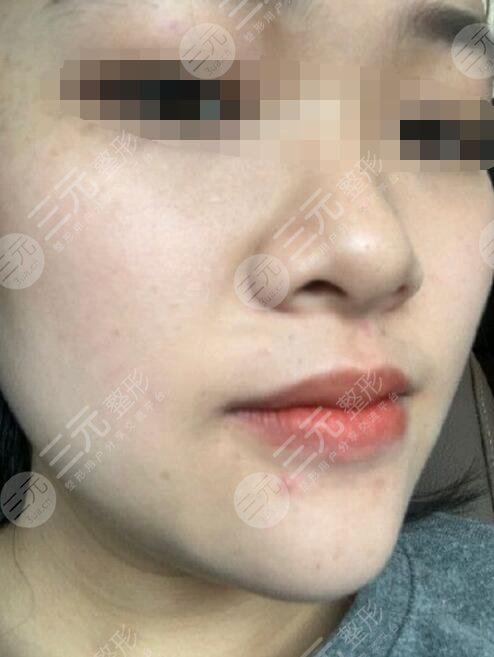 欧洲之星去斑后
