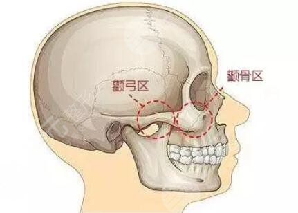 做颧骨手术注意事项