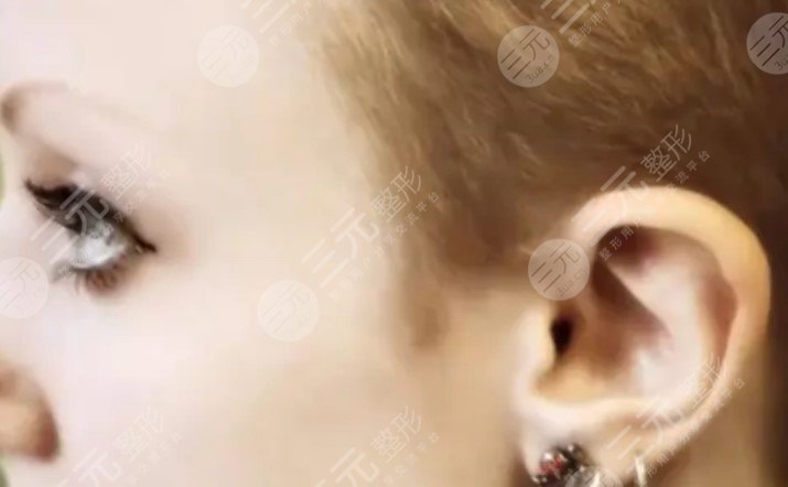 颅耳角在30°-60°之间整形多少钱