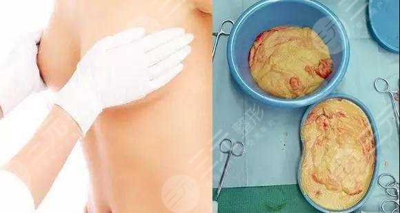 取奥美定手术要花多少钱