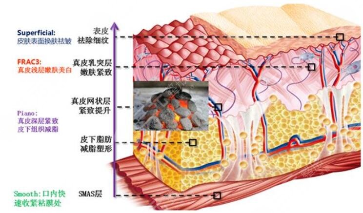 热玛吉的缓解原理