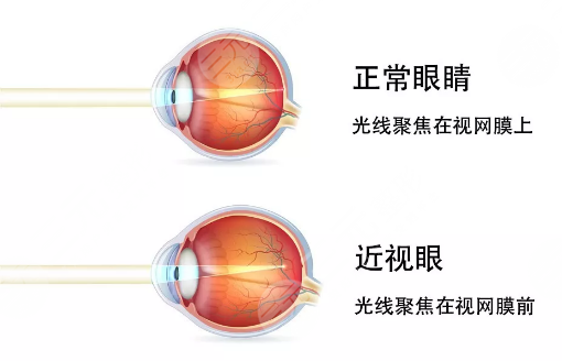 成都近视眼手术费用多少