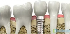 国内种植牙技术成熟吗，怎么样？牙齿修复科普分享！