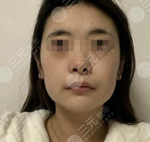 注射瘦脸的具体操作步骤是怎样的