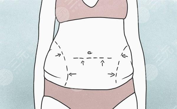 国内吸脂好还是去韩国吸脂好