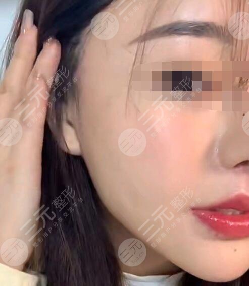 热玛吉后