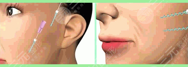 提升抗皱后多久可以做热玛吉