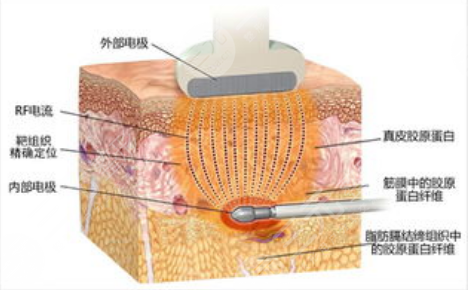 超脂塑的费用是多少