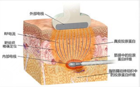 超脂塑手术选择什么样的医院呢